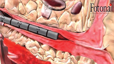 尿道内レーザープローブで尿道に直接照射します。