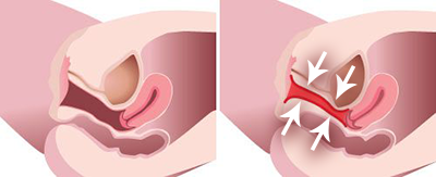 尿道や膣とその周囲の筋肉がしっかりして尿漏れが減少します