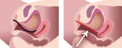 膀胱後壁の組織がしっかりとして上方に持ち上がってきます。