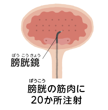 ボツリヌス療法